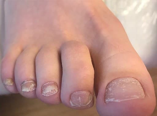 Voor-foto van vier aangetaste teennagels vóór de tiptoe behandeling