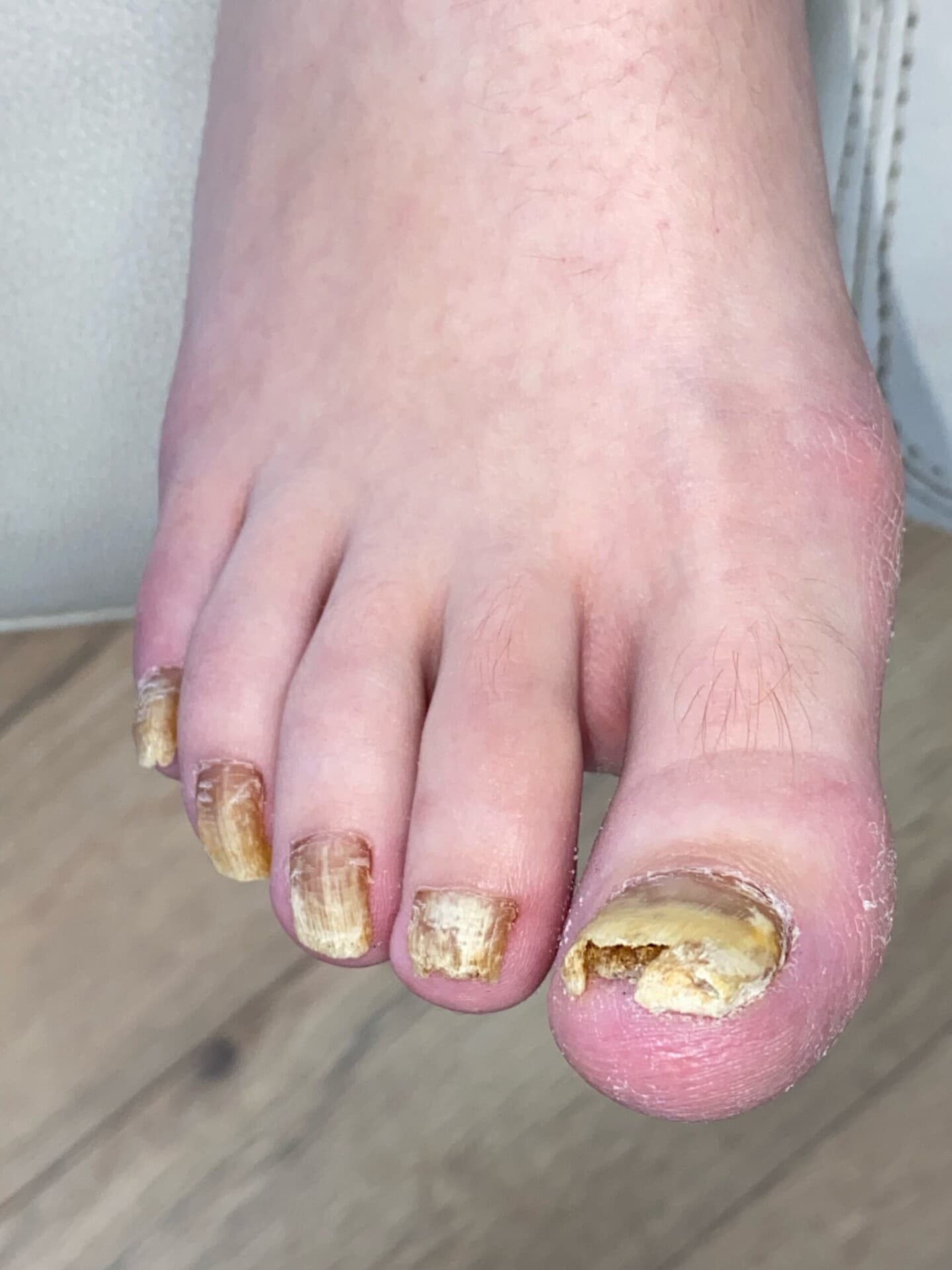Voor-foto van de kalknagels bij een meisje van 11 jaar vóór de tiptoe behandeling