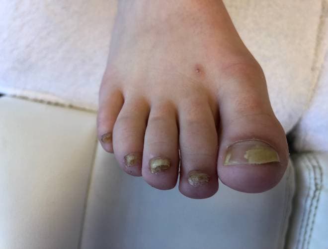 Voor-foto van de kalknagels bij een meisje van 7 jaar vóór de tiptoe behandeling