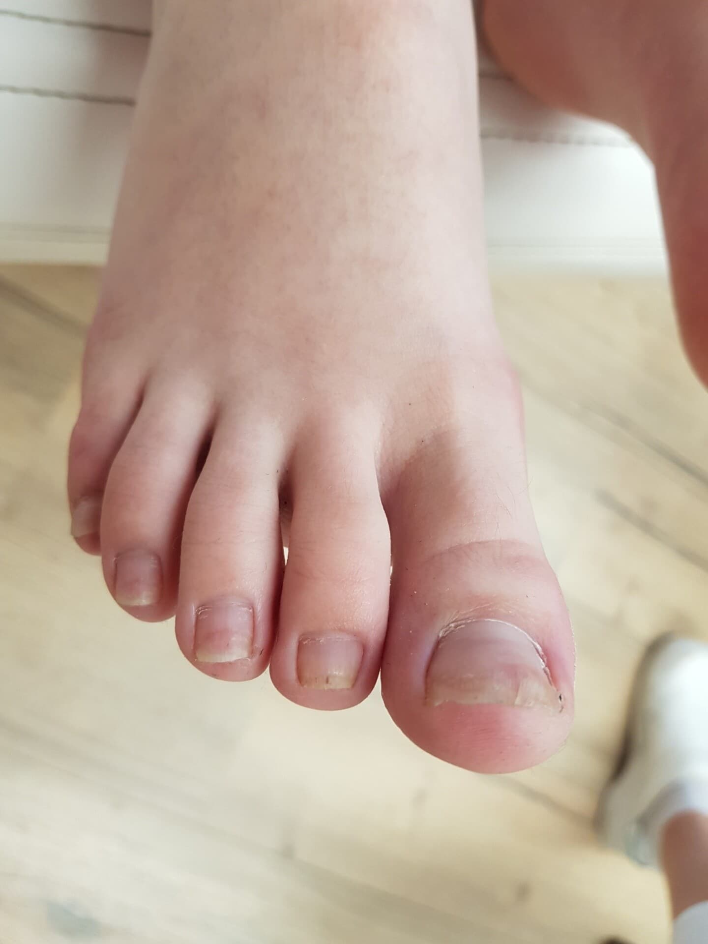 Schone, gezonde nagel na de tiptoe kalknagelbehandeling