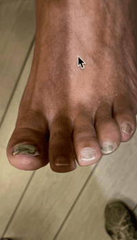 Aangetaste kalknagel voor de tiptoe behandeling