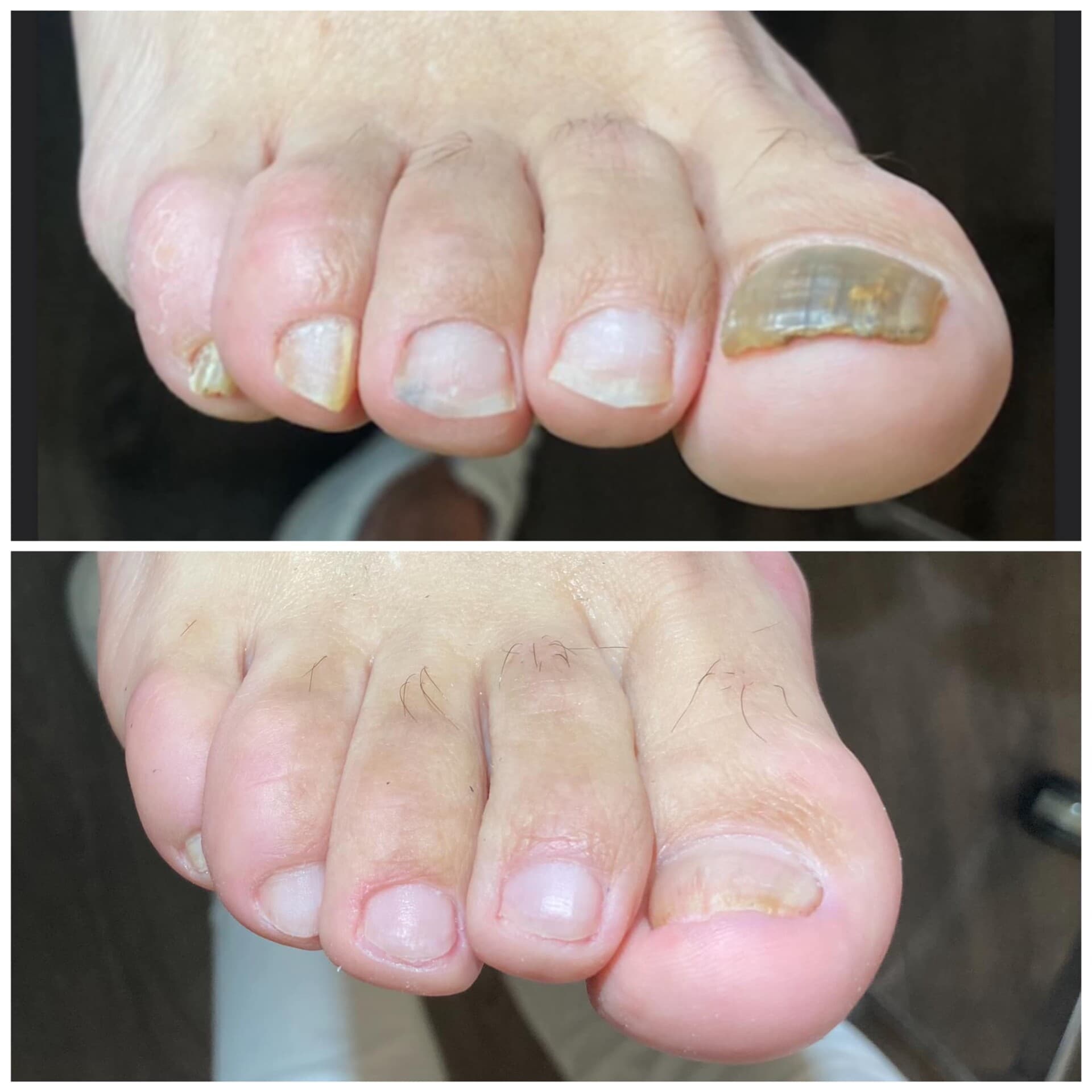 Voor- en na-foto van een kalknagelbehandeling bij tiptoe