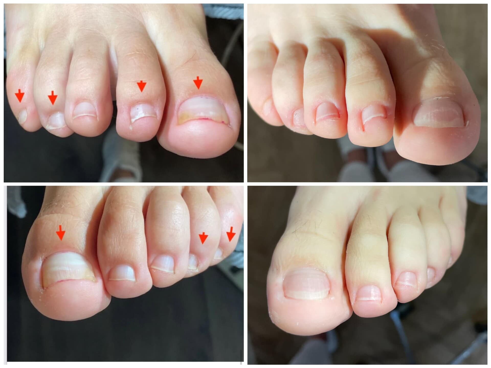 Voor- en na-foto van een kalknagelbehandeling bij tiptoe