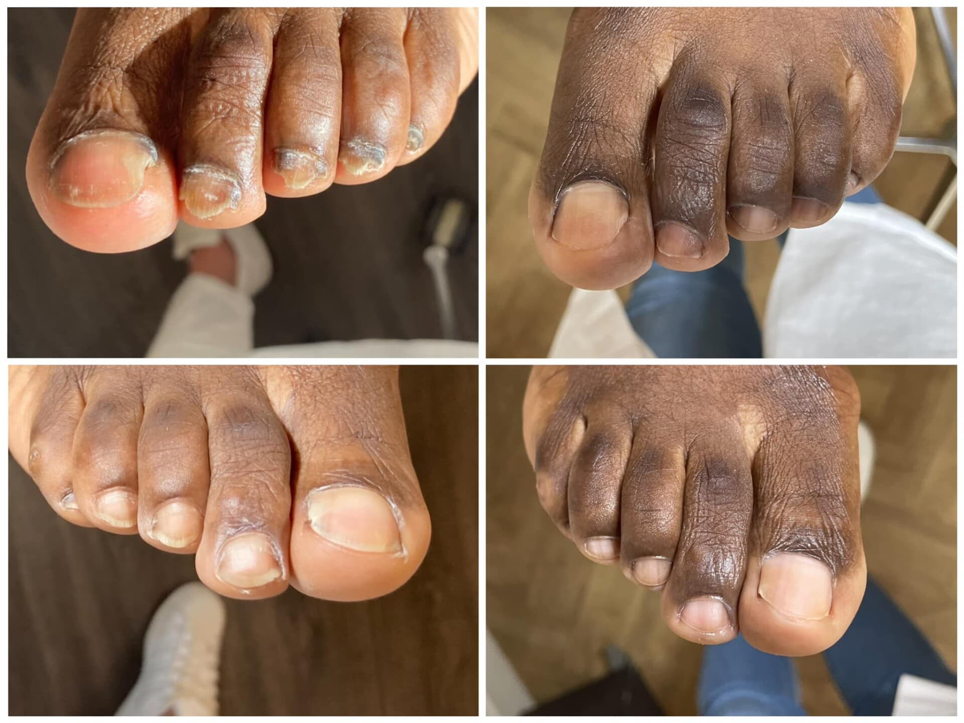 Voor- en na-foto van een kalknagelbehandeling bij tiptoe