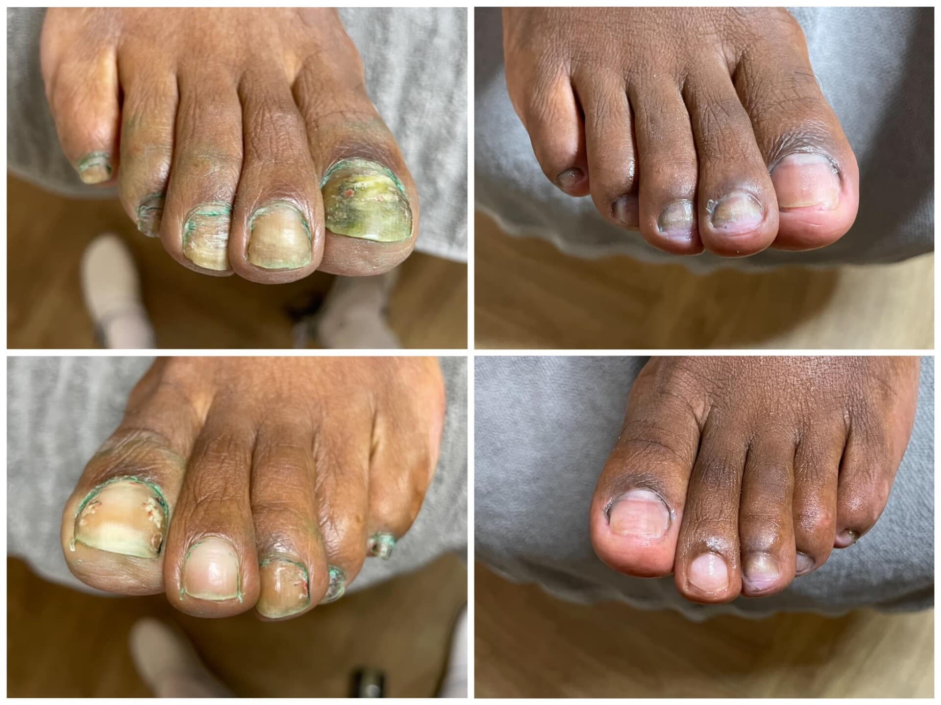 Voor- en na-foto van een kalknagelbehandeling bij tiptoe