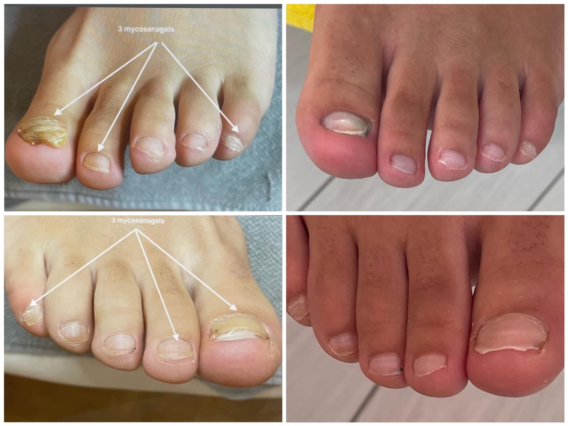 Voor- en na-foto van een kalknagelbehandeling bij tiptoe