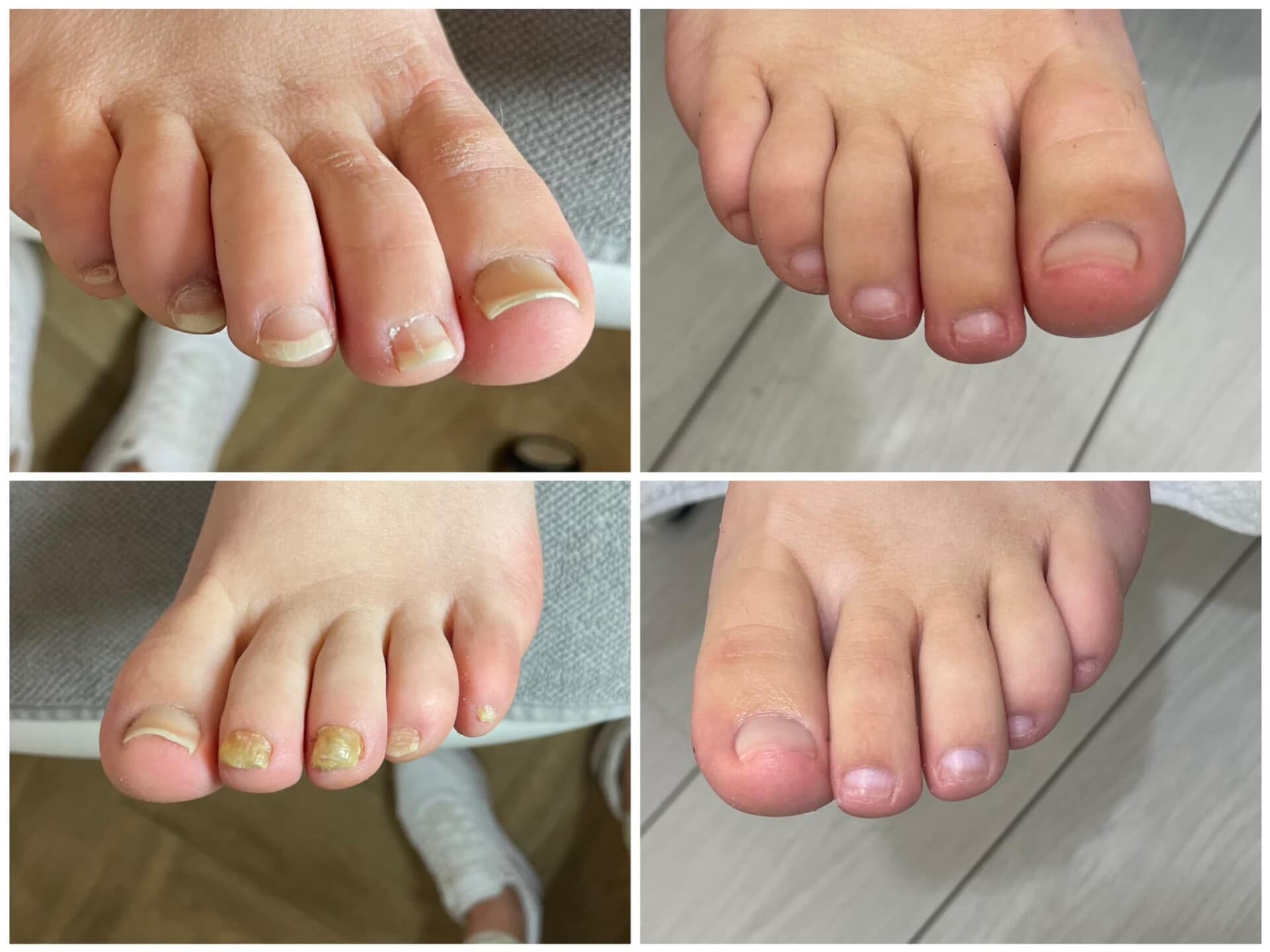 Voor- en na-foto van een kalknagelbehandeling bij tiptoe
